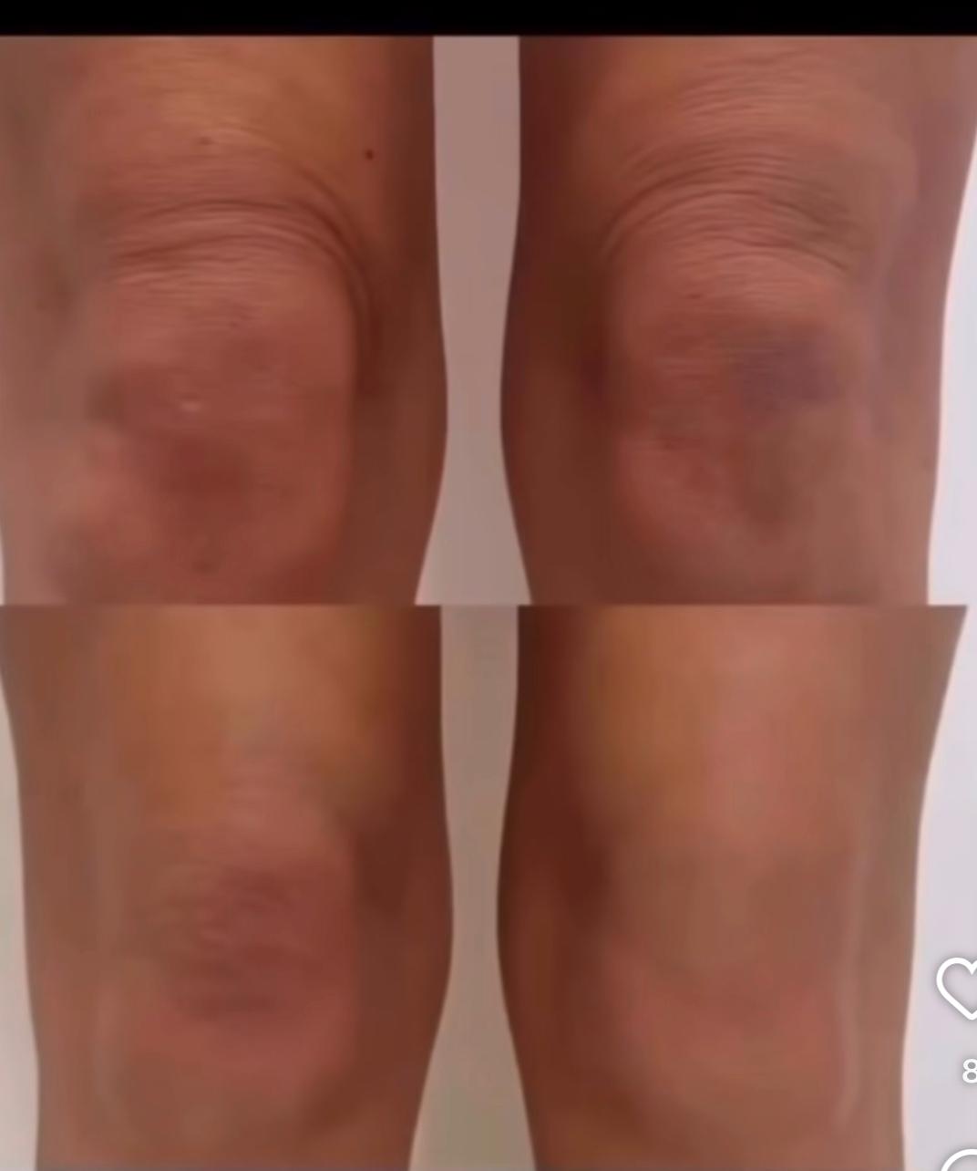 Treatment result