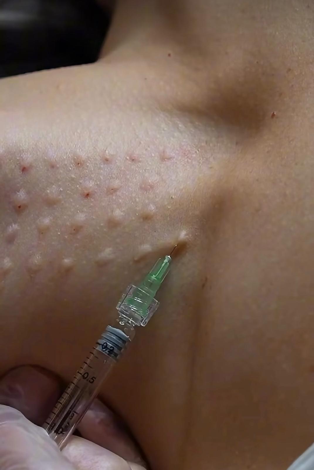 Treatment result